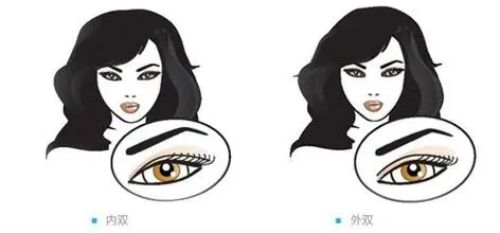 贵州省第二人民医院整形美容科双眼皮手术全过程，医院好评连连