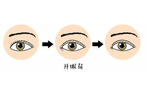 郑州陇海医院整形科开眼角真实体验反馈+科室介绍