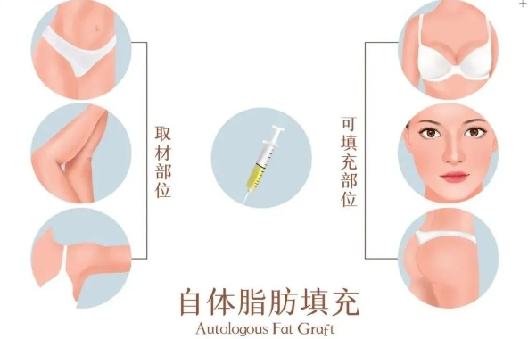 许昌市人民医院整形美容科玻尿酸填充面部怎么样？医生技术能力强，效果自然
