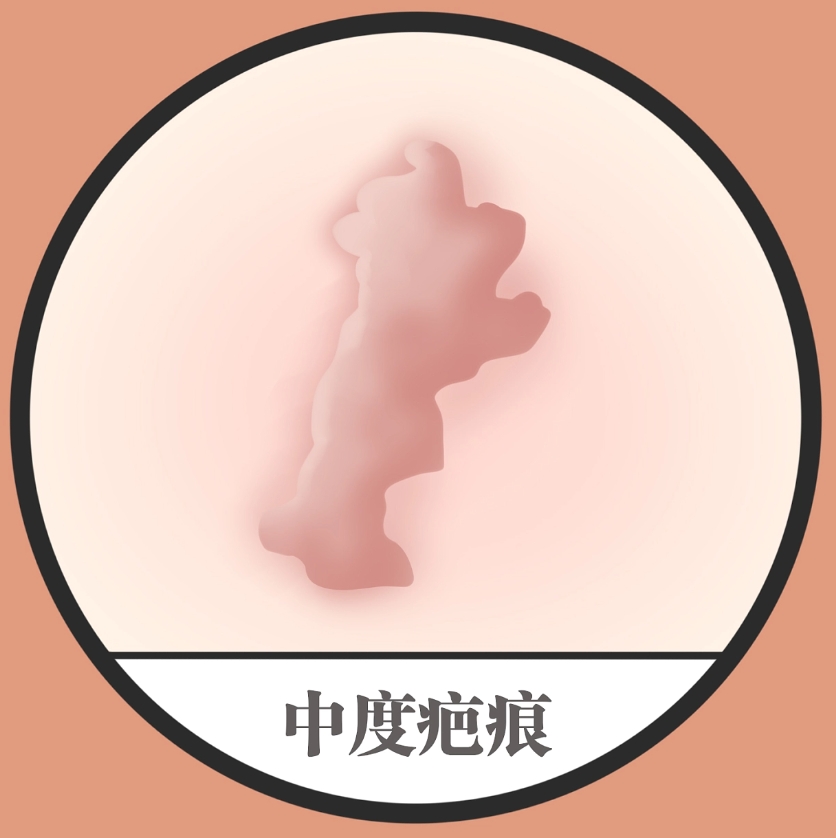 上海九院刘伟祛疤怎么样？疤痕切除效果好吗？疤痕修复案例一览