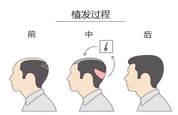 南昌植发手术需要多少钱?这三家专业植发医院值得你信赖