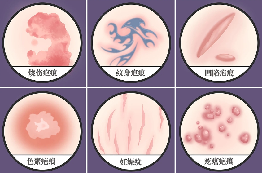 中国医学科学院整形外科医院王连召调节疤痕怎么样？技术优势+案例
