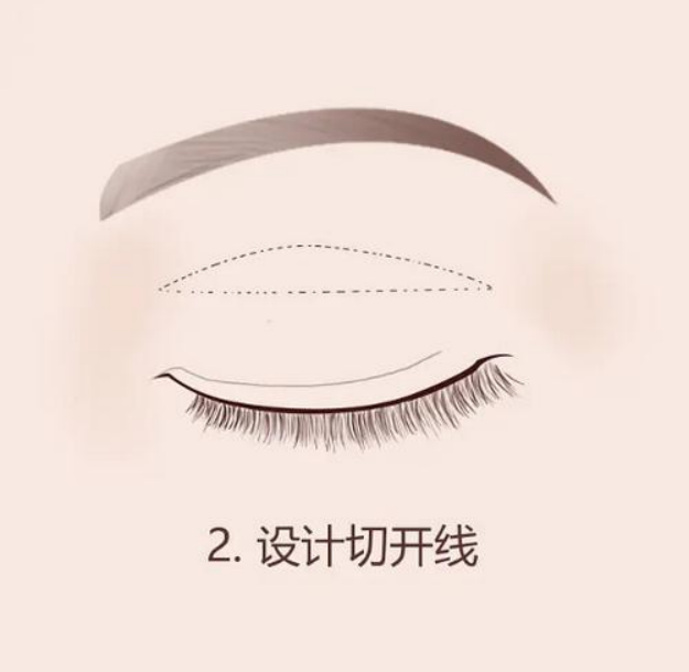 大连割眼袋费用大概多少钱?这三家整形医院值得了解下
