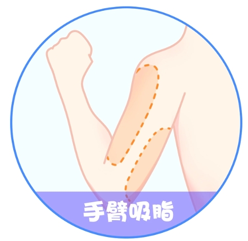 无锡手臂抽脂要多少钱?有哪些技术比较好的口碑医院？