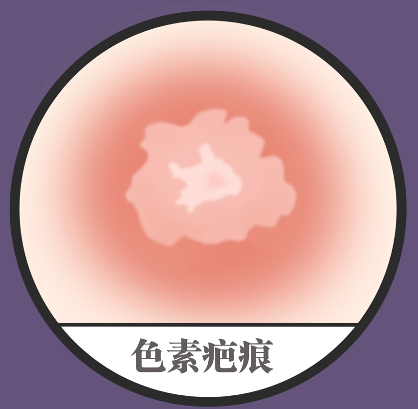 青岛市城阳区人民医院烧伤科疤痕手术介绍，内附2024费用参考真人案例详情