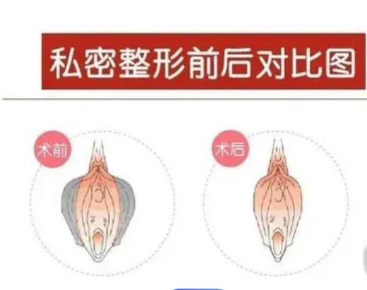 北京私密紧缩手术大概多少钱?三家医院口碑爆棚，让你安心变美！