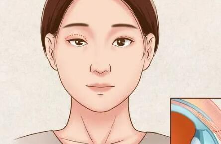 杭州做双眼皮价格？参考价格|医院名单分享