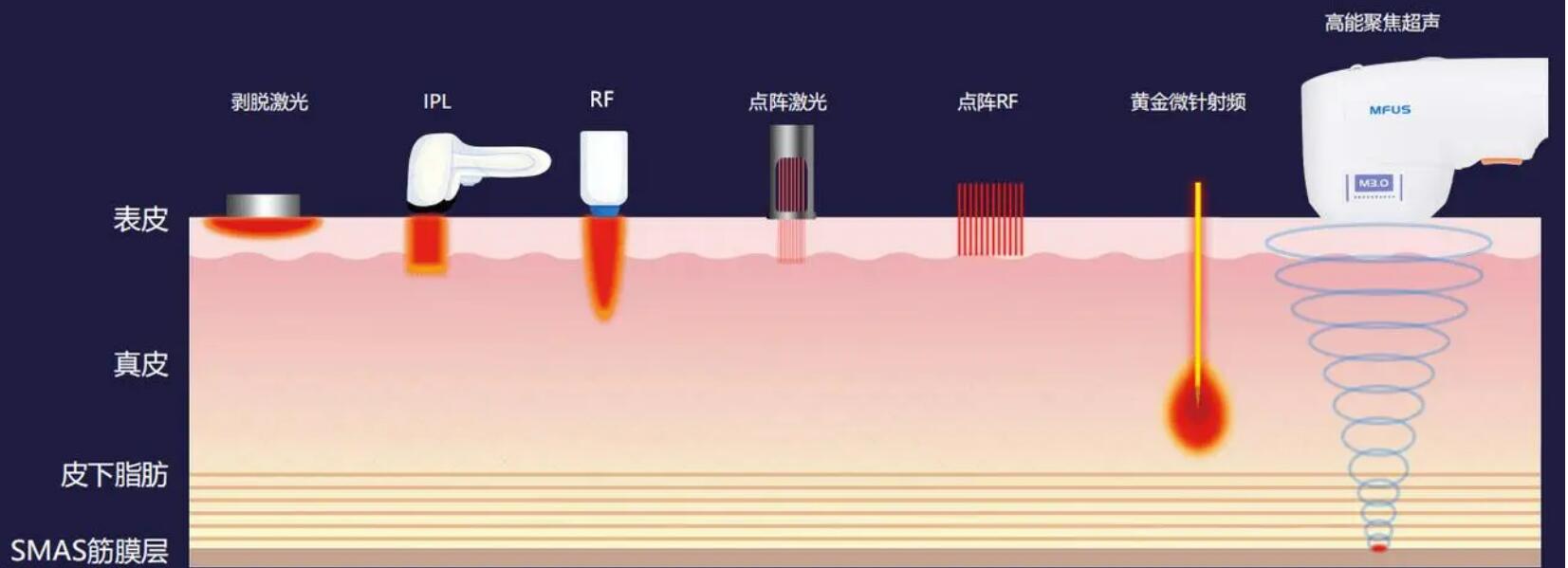 潍坊全脸超声炮多少钱?三家人气官方认证医美医院揭晓