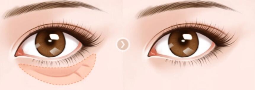 长春做眼袋手术要多少钱？三大优秀医美医院详细介绍