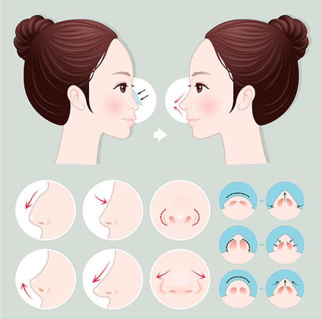 长沙隆鼻手术多少钱左右?实力医美医院一定要来看