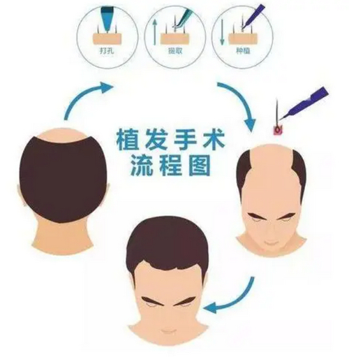 成都植发整形2024价格参考，内附实力医院推荐