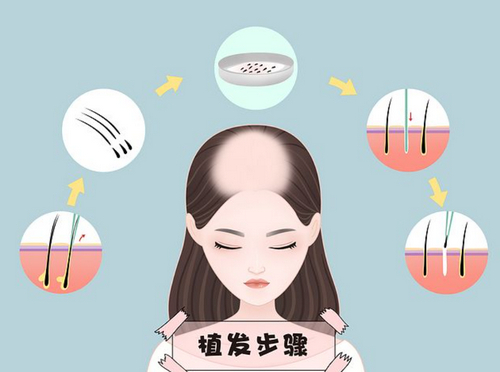 武汉植发整形怎么样？内附实力医院推荐+2024价格参考