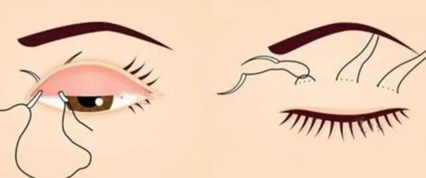 宜春做双眼皮手术多少钱?三大人气医美医院分享
