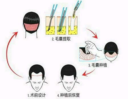 东莞植发发际线需要多少钱？人气医院来了\主打一个靠谱