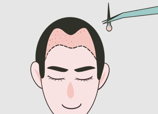 郑州美人尖种植价格多少？这几家实力口碑上榜