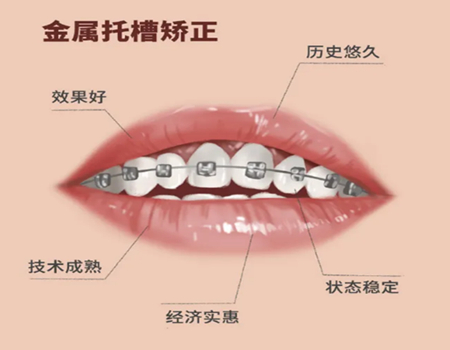 北京矫正牙齿价格多少？推荐三家医院咨询了解