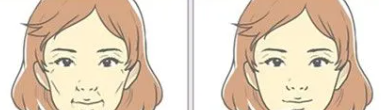 面部溶脂9.png