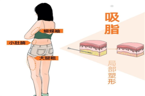 吸脂2.jpg