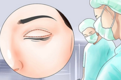 暨南大学附属第一医院双眼皮怎么样？眼整形收费全解析