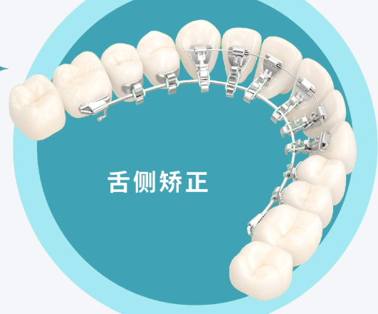 舌侧矫正五万够了吗，在线咨询获取报价