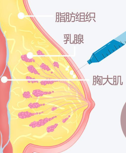 丰胸针一般要打多少支才有效果，正规医美_实力不俗