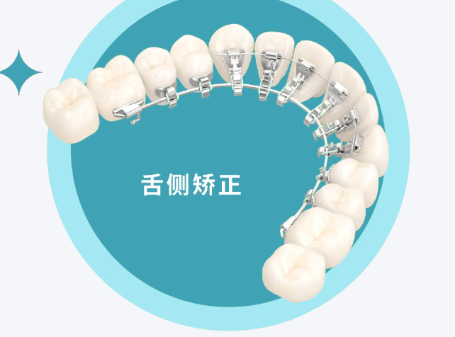 舌侧矫正优缺点及价格，技术、价格全解析