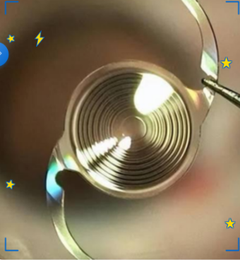 白内障晶体医保可以报销吗，详情一览