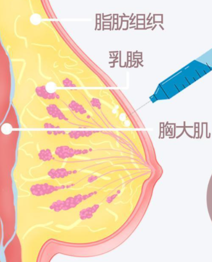 丰胸针多久恢复正常，高性价比、口碑推荐