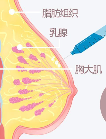 丰胸针多少钱一针有用吗，看了不亏！