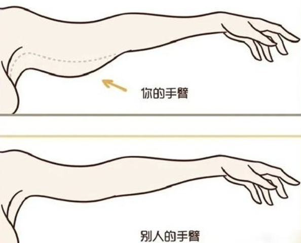 东莞上臂黄金微雕射频辅助吸脂（BodyTite）医院做之前要注意什么？市中医院医学美容科